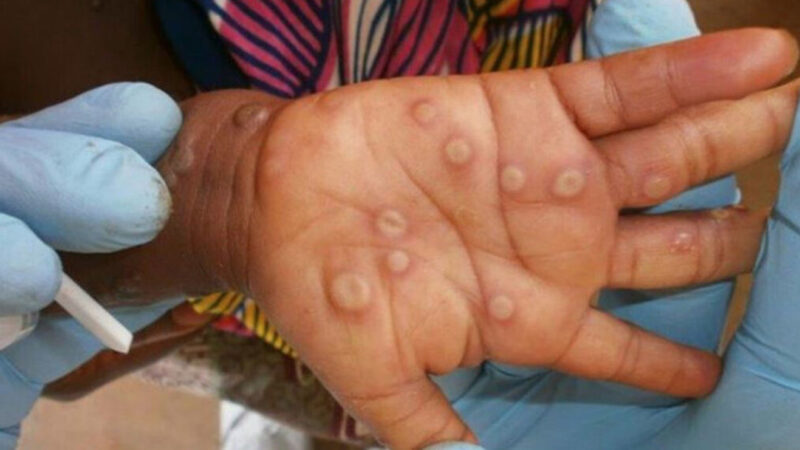 Mpox Situation in Pakistan